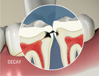 root canal